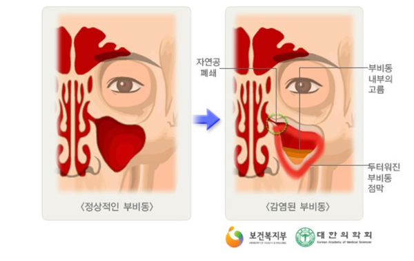 부비동염이 생기면 코 양쪽에 있는 빈 공간인 부비동에 누런 코가 고이게 된다./국가건강정보포털 